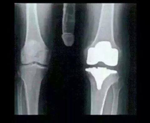 måtte på røntgen med ødelagt kne i dag.... :P